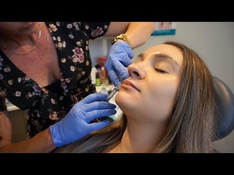 WATCH ME GET LIP FILLER FOR THE FIRST TIME! | Jan @ Subbio Plastic Surgery & Med Spa