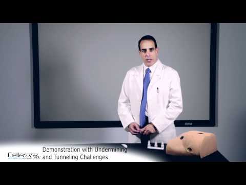 Undermining and Tunneling Challenges using CellerateRX Activated Collagen