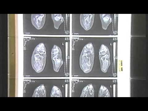 Infiammazione delle articolazioni delle gambe Urti sul polso