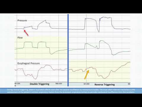 Reverse Triggering vs Double Triggering in Ventilator Dyssynchrony