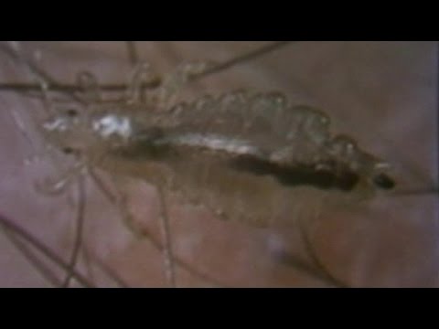 Are head lice becoming harder to kill?