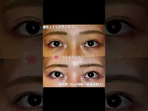 医学科 厚い瞼を薄くする　Roof切除&眼輪筋削ぎ