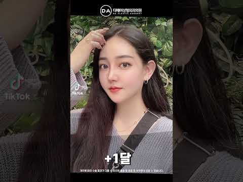 미니리프팅+비절개눈매교정+코성형