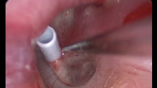 Endoscopic Tympanostomy Tube Placement - Colocación de tubo de drenaje endoscópica