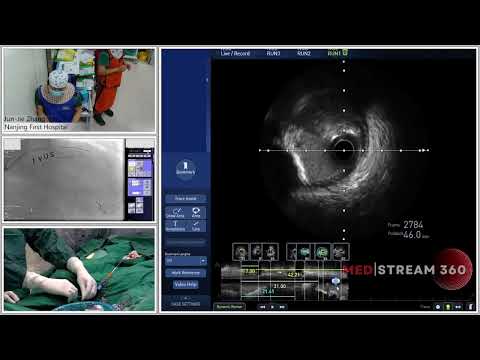 IVUS-Guided PCI For LM Bifurcation Using DK-CRUSH Technique