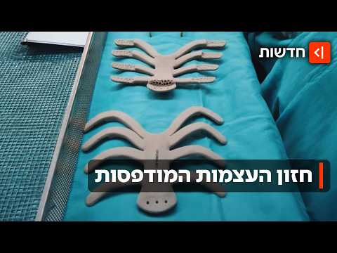 ניתוח ישראלי ראשון בעולם עשה שימוש בעצמות מודפסות להחלפת בית חזה