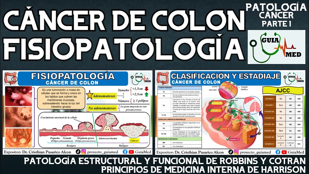 CÁNCER DE COLON FISIOPATOLOGÍA | GuiaMed