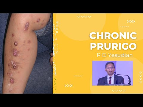Chronic prurigo - a comprehensive review, including treatment