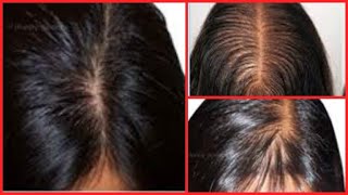 HOW TO GET RID OF THINNING HAIR, BALD SPOTS AND GROW LONG HEALTHY HAIR FAST,  2 STEPS TO THICK HAIR
