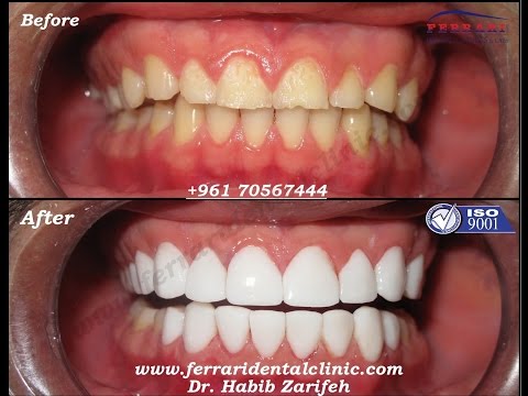 download lagu mp3 mp4 Hollywood Smile Lebanon, download lagu Hollywood Smile Lebanon gratis, unduh video klip Hollywood Smile Lebanon