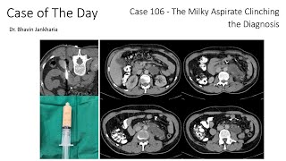 Case of the Day - 106 - 2025 09 22 - The Milky Aspirate Clinching the Diagnosis
