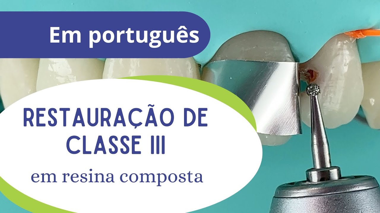 Restauração de Classe III em Resina Composta