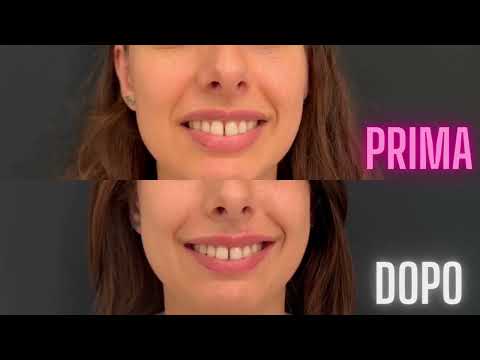 Video Gummy Smile — trattamento sorriso gengivale Dr Lips