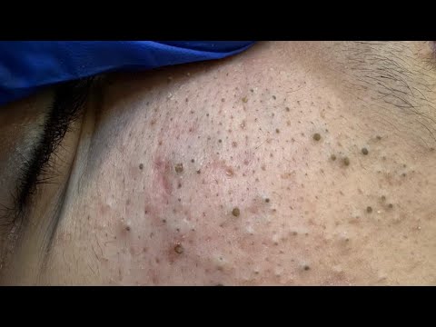 [ASMR] Ultimate Facial Care Routine for Acne and Blackheads