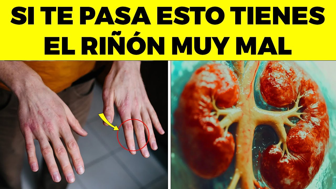 SI Sientes Esto RARO TU RIÑÓN YA NO FUNCIONA