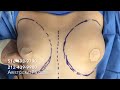 Fat Grafting for Breast Asymmetry