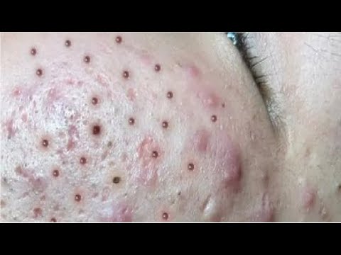 Blackhead removal with NaSa Spa | Satisfying and Relaxation with NaSa Beauty Spa