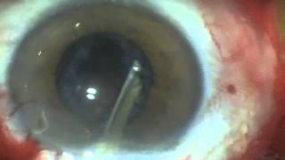 MSICS surgery - Carlos Gomez