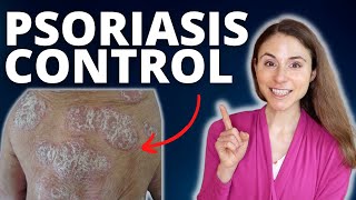 TOP 5 TIPS TO CONTROL PSORIASIS FLARES 😊 DERMATOLOGIST @DrDrayzday