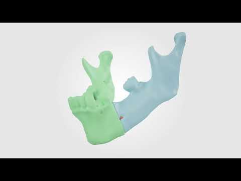 KLS Martin's IPS® Trauma