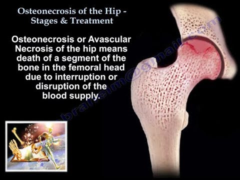 Osteonecrosis Of The Hip Stages & Treatment - Everything You Need To Know - Dr. Nabil