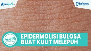 Mengenal Epidermolisi Bulosa yang Bisa akibatkan Kulit Melepuh, dari Tingkatan Ringan hingga Berat