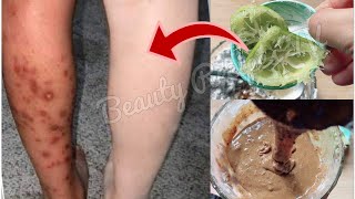 How to get rid of Dark spots, Scar, Mosquito Bites marks from legs, Hyperpigmentation on legs fast.