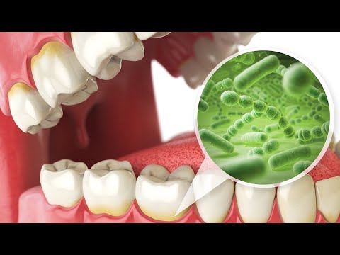 Acute Necrotizing Ulcerative Gingivitis