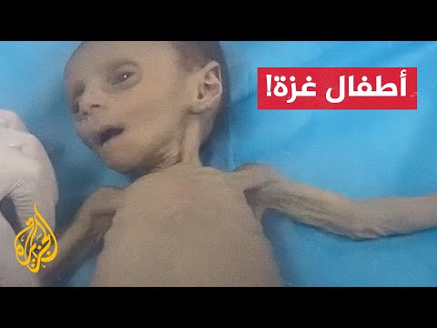 "مصابون بسوء التغذية".. توافد يومي لأطفال مرضى على مستشفيات غزة