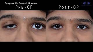 Ptosis Correction by Levator Resection