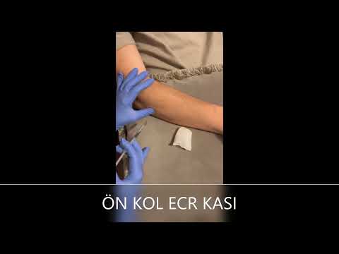 ESANSİYEL TREMOR BOTOX TEDAVİSİ