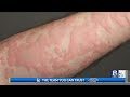 Handling Hives