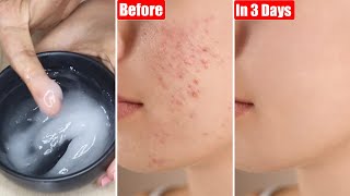 I applied👆🏼this on my Small Bumps, Pimples, Whiteheads & Acne-Got Clear Smooth Skin in Just 3 Days