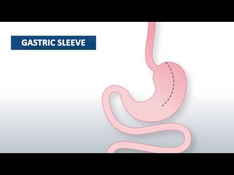 What is gastric sleeve surgery? | Beaumont Health