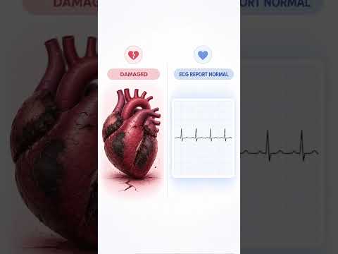 A Normal ECG Doesn't Always Mean a Healthy Heart