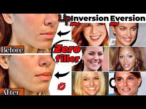 Botox Lip Flip Vorher und Nachher | Alles, was Sie wissen müssen