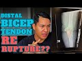 Re-rupture Bicep Tendon?? (Surgical Route) | Distal Bicep Tendon 2023