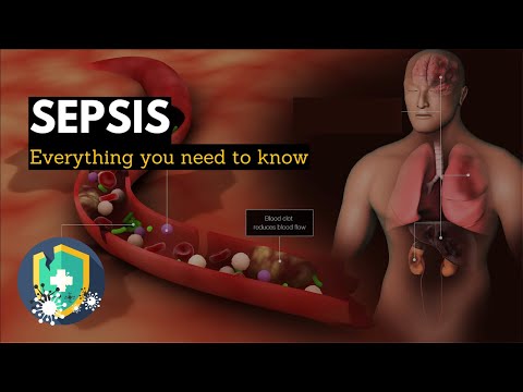 Sepsis: Everything You Need to Know