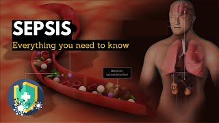 Sepsis: Everything You Need to Know