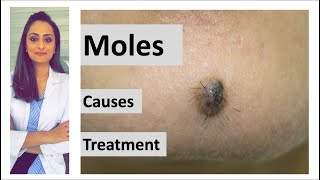 How to remove a mole | Mole: causes  & removal | home remedy | Dermatologist | Dr. Aanchal Panth