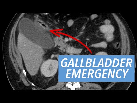 Emergency Radiology Case Series: Acute Diagnoses of the Abdomen & Pelvis