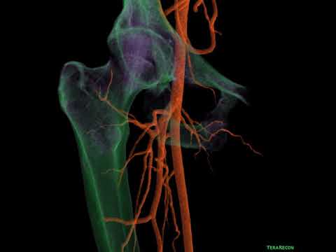 another common femoral artery