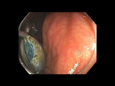 Resección mucosa endoscópica (RME) de adenomas serrados sésiles del colon transverso