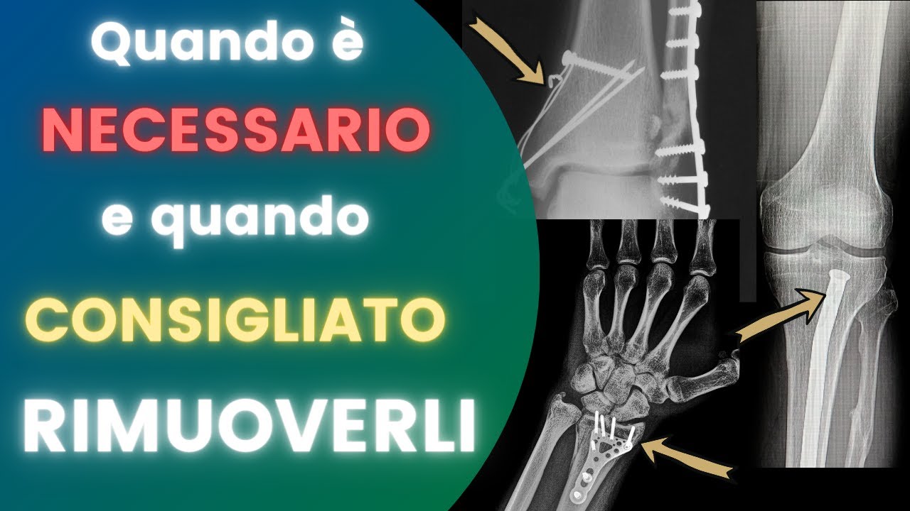 Mezzi di sintesi | Quando è NECESSARIO e quando CONSIGLIATO rimuoverli.