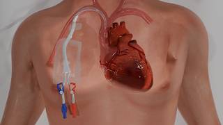 Types of Vascular Access Devices | Medical 3D Animation for Healthcare