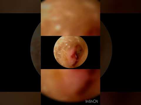 Ear cleaning Ear buds | Dr. Akanksha Jain