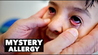HIS EYES WERE SWOLLEN SHUT... (Mystery Allergy) | The Most Adorable Kid Ever | Dr. Paul