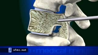 Medical Minute: Kyphoplasty with Dr. Scott (2)