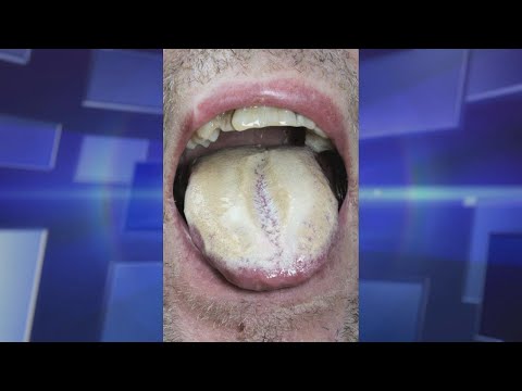 Is Oral Thrush Caused by Antibiotics?