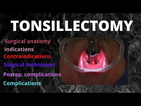 066. Tonsillectomy  #tonsillitis